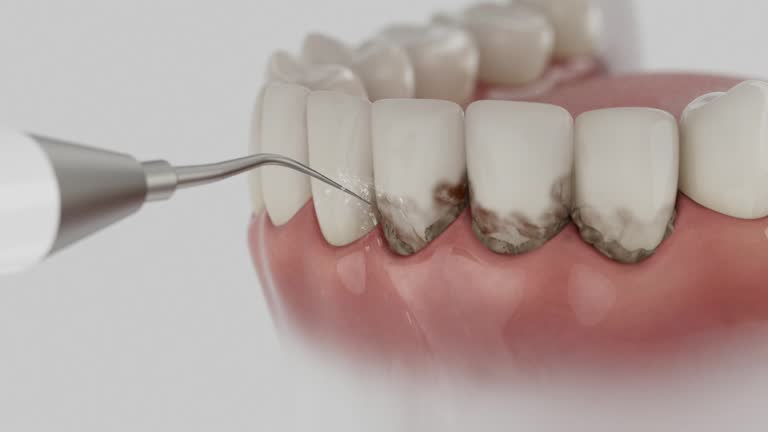 Reliable Tooth Extraction contractor in Beavercreek, OH by Smile Center Dentistry